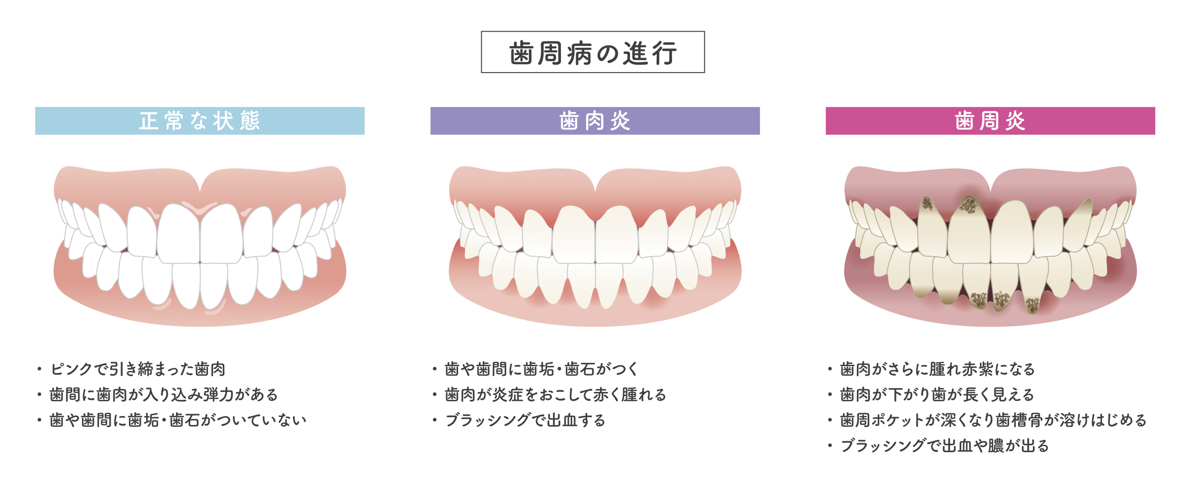 歯周病の進行