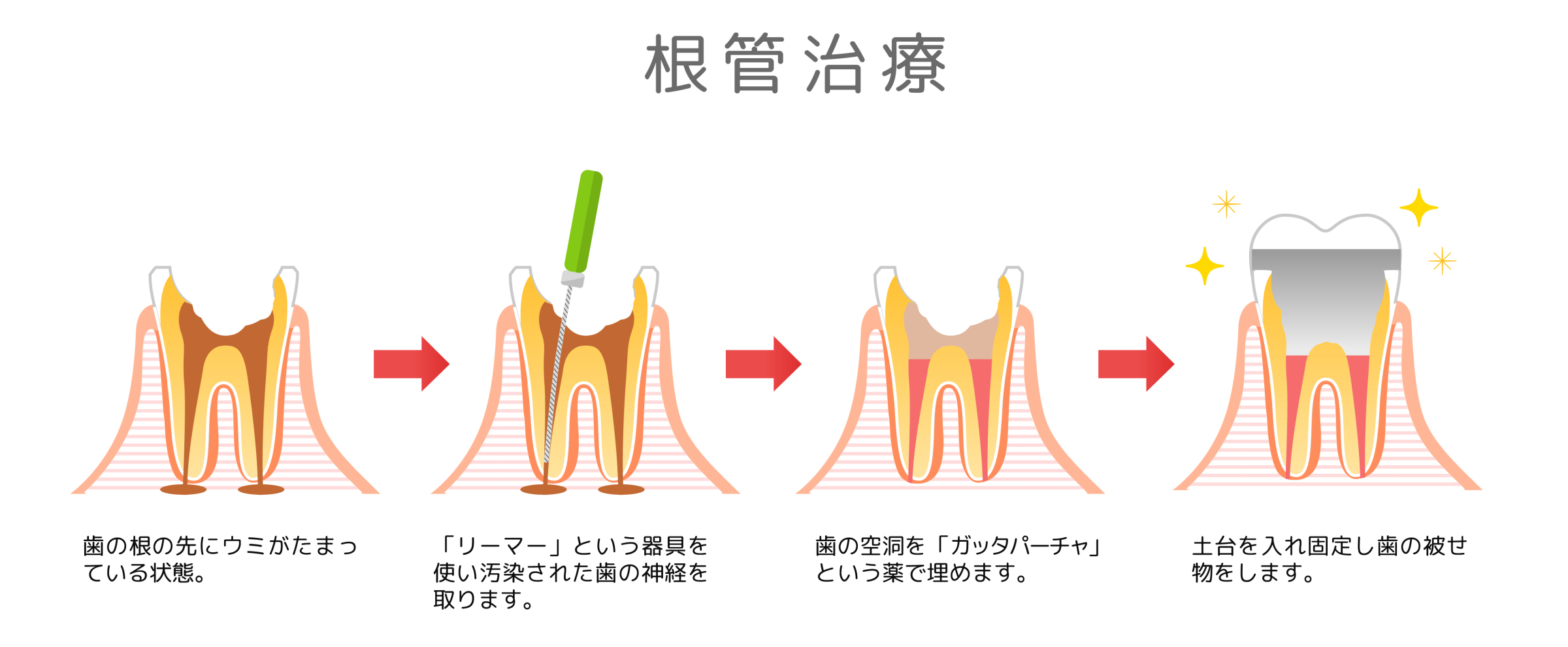 歯の根の治療